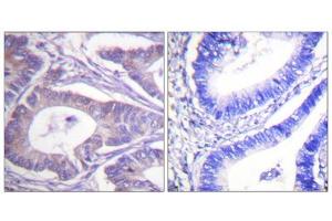 Immunohistochemistry analysis of paraffin-embedded human colon carcinoma tissue, using Vimentin antibody. (Vimentin antibody  (C-Term))