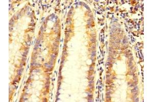 Immunohistochemistry of paraffin-embedded human colon cancer using ABIN7145670 at dilution of 1:100