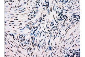 Immunohistochemical staining of paraffin-embedded Carcinoma of kidney tissue using anti-BRAFmouse monoclonal antibody.