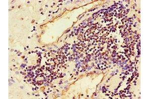 Immunohistochemistry of paraffin-embedded human prostate cancer using ABIN7160009 at dilution of 1:100 (JNK antibody  (AA 5-300))