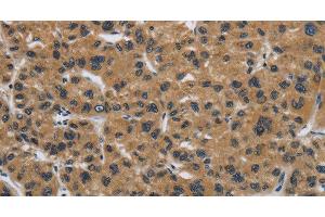 Immunohistochemistry of paraffin-embedded Human liver cancer tissue using Claudin 2 Polyclonal Antibody at dilution 1:50 (Claudin 2 antibody)