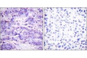 Immunohistochemistry analysis of paraffin-embedded human breast carcinoma, using MDM2 (Phospho-Ser166) Antibody. (MDM2 antibody  (pSer166))