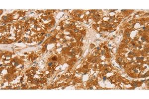 Immunohistochemistry of paraffin-embedded Human thyroid cancer tissue using CD43 Polyclonal Antibody at dilution 1:60 (CD43 antibody)