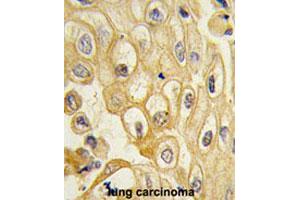 Formalin-fixed and paraffin-embedded human lung carcinomareacted with ROR1 polyclonal antibody , which was peroxidase-conjugated to the secondary antibody, followed by AEC staining. (ROR1 antibody  (AA 112-399))