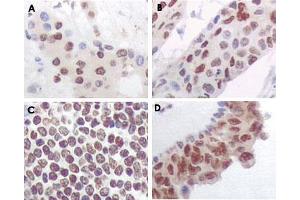 Immunohistochemical analysis of paraffin-embedded human liver carcinoma (A), esophagus carcinoma (B), normal spleen tissue(C), breast carcinoma (D), showing nuclear and cytoplasmic localization using MAPKAPK5 monoclonal antibody, clone 7H10B4  with DAB staining. (MAPKAP Kinase 5 antibody)