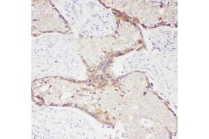 Anti- CD62P antibody, IHC(P) IHC(P): Human Mammary Cancer Tissue (P-Selectin antibody  (N-Term))
