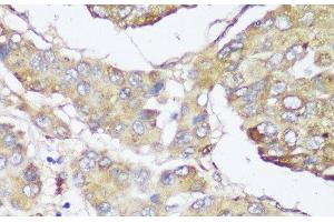 Immunohistochemistry of paraffin-embedded Human liver cancer using FKBP10 Polyclonal Antibody at dilution of 1:150 (40x lens). (FKBP10 antibody)