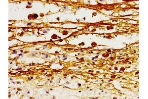 Immunohistochemistry of paraffin-embedded human melanoma using ABIN7161199 at dilution of 1:100 (L1CAM antibody  (AA 995-1119))