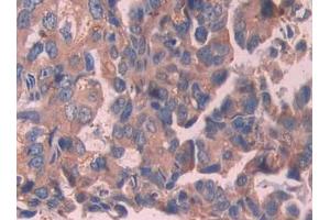 Used in DAB staining on fromalin fixed paraffin- embedded stomach cancer tissue (IL-24 antibody  (AA 51-206))