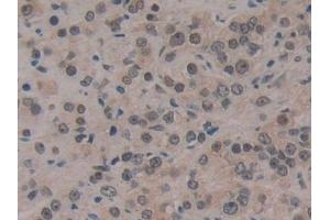 Detection of CIRBP in Human Prostate cancer Tissue using Polyclonal Antibody to Cold Inducible RNA Binding Protein (CIRBP)