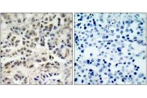 Immunohistochemistry analysis of paraffin-embedded human lung carcinoma tissue, using p27 Kip1 (Ab-10) Antibody. (CDKN1B antibody  (AA 1-50))