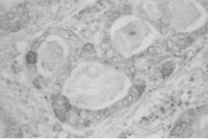IHC on human uterine cervical adenocarcinoma (RCAS1 antibody)