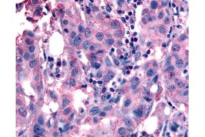 Anti-NANP antibody IHC of human Breast, Carcinoma. (NANP antibody  (Internal Region))