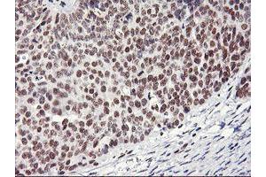 Immunohistochemical staining of paraffin-embedded Adenocarcinoma of Human ovary tissue using anti-RNF113B mouse monoclonal antibody. (RNF113B antibody)