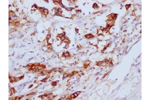 IHC image of ABIN7180656 diluted at 1:100 and staining in paraffin-embedded human gastric cancer performed on a Leica BondTM system. (CEACAM5 antibody)
