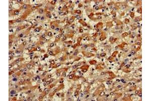 Immunohistochemistry of paraffin-embedded human liver cancer using ABIN7173471 at dilution of 1:100 (TRIM59 antibody  (AA 126-181))
