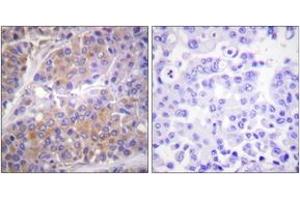 Immunohistochemistry analysis of paraffin-embedded human breast carcinoma, using p70 S6 Kinase (Phospho-Ser371) Antibody. (RPS6KB1 antibody  (pSer371))