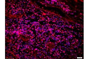 Formalin-fixed and paraffin-embedded human lung carcinoma labeled with Anti-FOXN1 Polyclonal Antibody, Unconjugated (ABIN1387592) 1:200, overnight at 4°C, The secondary antibody was Goat Anti-Rabbit IgG, Cy3 conjugated used at 1:200 dilution for 40 minutes at 37°C. (FOXN1 antibody  (AA 321-420))