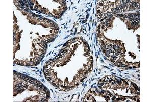 Immunohistochemical staining of paraffin-embedded Adenocarcinoma of breast tissue using anti-DCXR mouse monoclonal antibody. (DCXR antibody)