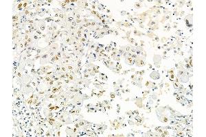 ABIN6266359 and ABIN6276704 at 1/100 staining Human lung cancer by IHC-P.