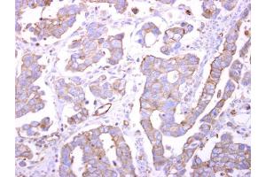 IHC-P Image Bif-1 antibody detects Bif-1 protein at cytosol on human ovarian carcinoma by immunohistochemical analysis.