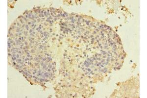 Immunohistochemistry of paraffin-embedded human cervical cancer using ABIN7173459 at dilution of 1:100 (TRIM51 antibody  (AA 160-452))