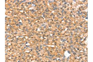 The image on the left is immunohistochemistry of paraffin-embedded Human prostate cancer tissue using ABIN7192491(SLC43A2 Antibody) at dilution 1/20, on the right is treated with synthetic peptide. (SLC43A2 antibody)