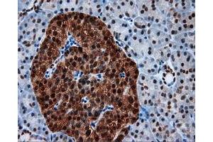 Immunohistochemical staining of paraffin-embedded Adenocarcinoma of colon tissue using anti-SIL1 mouse monoclonal antibody. (SIL1 antibody)