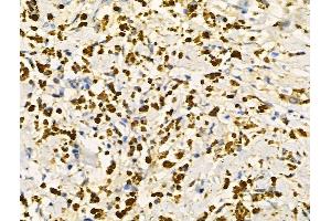 Phospho-SIRT6 (Ser10) Antibody at 1/100 staining Human ovarian cancer by IHC-P.