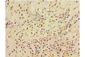 Immunohistochemistry of paraffin-embedded human breast cancer using ABIN7168521 at dilution of 1:100 (AHCYL1 antibody  (AA 31-260))