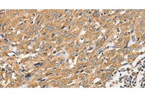 Immunohistochemistry of paraffin-embedded Human esophagus cancer tissue using ANGPTL7 Polyclonal Antibody at dilution 1:40 (ANGPTL7 antibody)