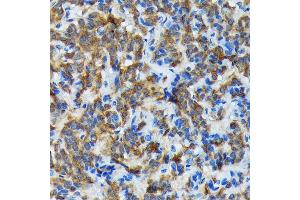 Immunohistochemistry of paraffin-embedded human thyroid cancer using Thyroid Peroxidase Rabbit mAb (ABIN7270865) at dilution of 1:100 (40x lens). (TPO antibody)