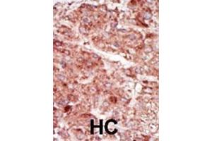 Formalin-fixed and paraffin-embedded human cancer tissue reacted with the primary antibody, which was peroxidase-conjugated to the secondary antibody, followed by AEC staining. (HK3 antibody  (C-Term))