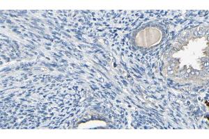 ABIN6272591 at 1/100 staining Human cervical cancer tissue by IHC-P. (IFI6 antibody)