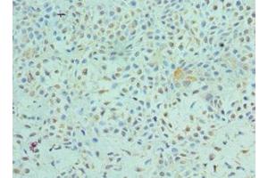 Immunohistochemistry of paraffin-embedded human breast cancer using ABIN7172544 at dilution of 1:100 (ETV6 antibody  (AA 1-300))