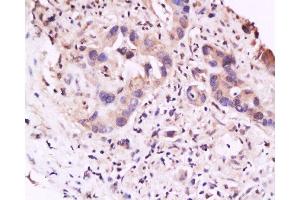 Formalin-fixed and paraffin embedded human gastric carcinoma labeled with Anti-IL-23R Polyclonal Antibody, Unconjugated  at 1:200 followed by conjugation to the secondary antibody and DAB staining (IL23R antibody  (AA 401-550))