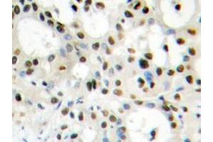 Immunohistochemistry analyzes of hnRNP A1 antibody in paraffin-embedded human liver carcinoma tissue. (HNRNPA1 antibody)