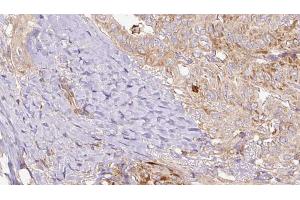 ABIN6267169 at 1/100 staining Human thyroid cancer tissue by IHC-P. (REPS1 antibody  (pSer709))