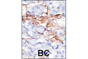 Formalin-fixed and paraffin-embedded human cancer tissue reacted with the primary antibody, which was peroxidase-conjugated to the secondary antibody, followed by DAB staining. (PDGFRL antibody  (C-Term))