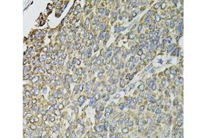 Immunohistochemistry of paraffin-embedded Human liver cancer using RASSF1 Polyclonal Antibody at dilution of 1:100 (40x lens). (RASSF1 antibody)