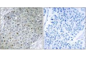 Immunohistochemistry analysis of paraffin-embedded human breast carcinoma tissue, using ETV4 Antibody.