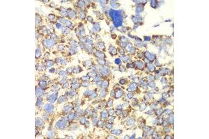 Immunohistochemistry of paraffin-embedded human esophageal cancer using GLUD2 antibody at dilution of 1:100 (x40 lens). (GLUD2 antibody)