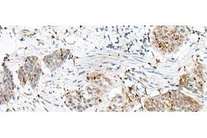 Immunohistochemistry of paraffin-embedded Human esophagus cancer tissue using PLCL2 Polyclonal Antibody at dilution of 1:50(x200) (PLCL2 antibody)