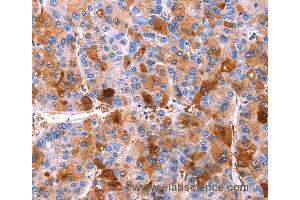Immunohistochemistry of Human thyroid cancer using ERN2 Polyclonal Antibody at dilution of 1:40 (ERN2 antibody)
