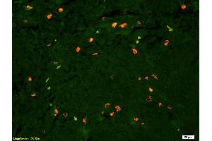 Formalin-fixed and paraffin embedded human glioma tissue labeled with Anti Lyn Polyclonal Antibody, PE conjugated (ABIN681493) at 1:200 dilution for 60 minutes at 37°C. (LYN antibody  (AA 201-300))