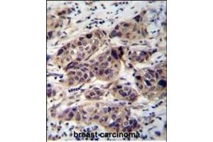 WDR42C Antibody (N-term) (ABIN655843 and ABIN2845256) immunohistochemistry analysis in formalin fixed and paraffin embedded human breast carcinoma followed by peroxidase conjugation of the secondary antibody and DAB staining. (DCAF8L2 antibody  (N-Term))