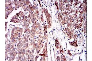 Immunohistochemical analysis of paraffin-embedded liver cancer tissues using SERPINA7 mouse mAb with DAB staining. (SERPINA7 antibody  (AA 168-302))