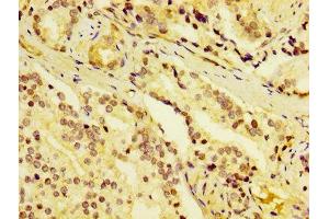 IHC image of ABIN7149752 diluted at 1:400 and staining in paraffin-embedded human prostate cancer performed on a Leica BondTM system. (Dermcidin antibody  (AA 20-110))