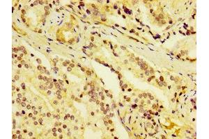 IHC image of ABIN7149752 diluted at 1:400 and staining in paraffin-embedded human prostate cancer performed on a Leica BondTM system.