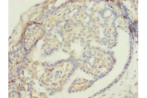 Immunohistochemistry of paraffin-embedded human breast cancer using ABIN7176453 at dilution of 1:100 (ZNF626 antibody  (AA 1-92))